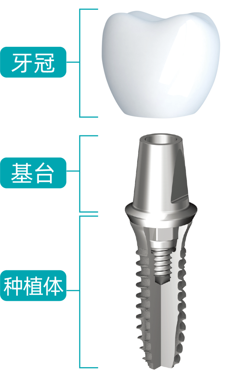 种植牙的原理